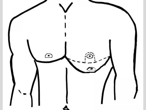 Ilustrace gynekomastie